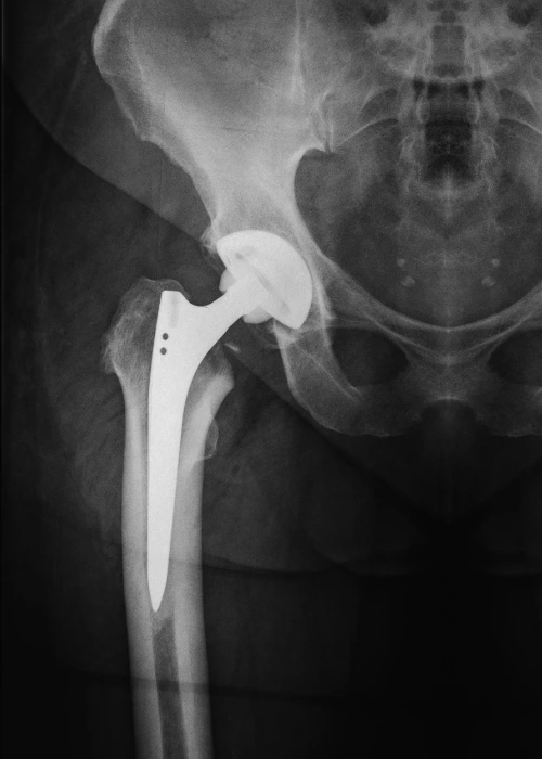 artroplastia cadera dr. francisco figueroa Traumatología en Hermosillo