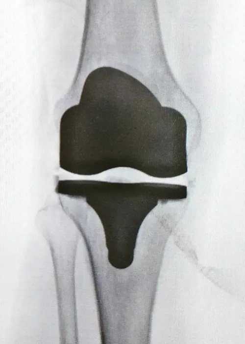 artroplastia total rodilla Traumatología en Hermosillo