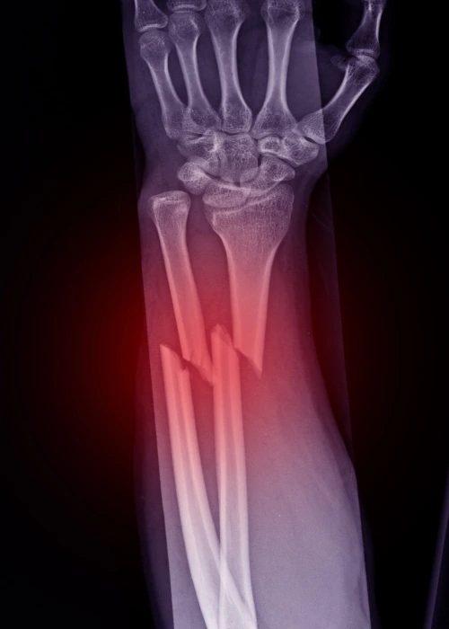 fractura dr. francisco figueroa Traumatología en Hermosillo