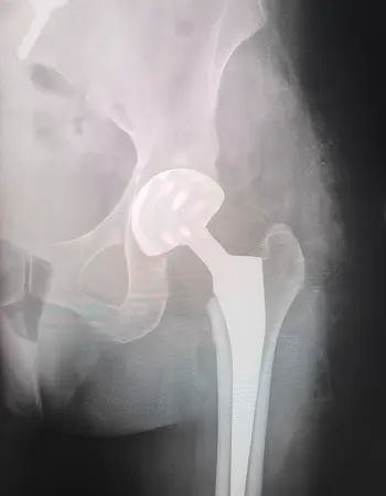 protesis de rodilla