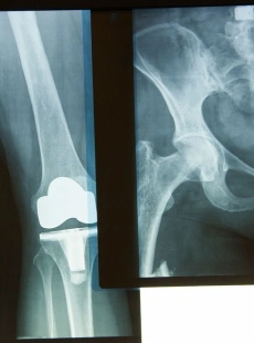 Cirugía de Prótesis de Cadera y Rodilla en Hermosillo